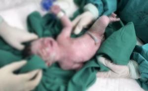 危重产妇分娩时咳痰像呕吐，上海医生20分钟成功完成剖宫产