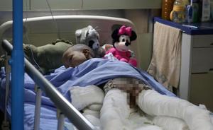 四川雅安4岁留守女童独自在家双腿被“烧焦”，恐面临截肢