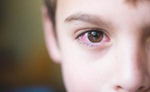 感染可诱发“视神经炎”，儿童发病急要及时治疗