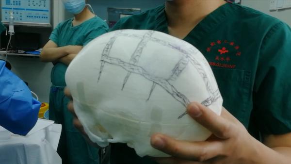 婴儿患狭颅症，3D打印建颅骨助力手术