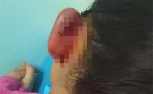 神木教育局回应幼儿园女童耳部受伤：涉事教师停职，警方调查