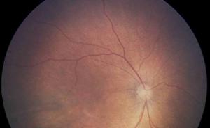 AI算法自动诊断早产儿视网膜病，准确率超大多数专业医生