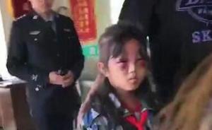 女孩遭继母打成“熊猫眼”， 黑龙江庆安警方：已传唤继母