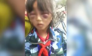 女孩疑遭继母打成“熊猫眼”，警方调查