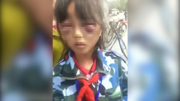 女孩疑遭继母打成“熊猫眼”，警方调查