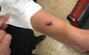 南京一医院保安抱住轻生患者被咬下一块肉：只想着不能松手