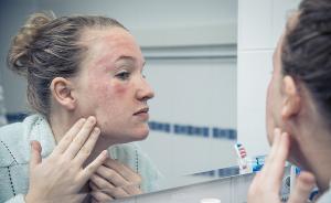 问答｜春季过敏肿成大红脸，皮肤科医生有什么好办法吗？