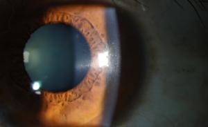近视远视手术废弃透镜再利用，可望治疗角膜疾病