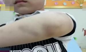 男童長期受傷學校報警，其父：多管閑事