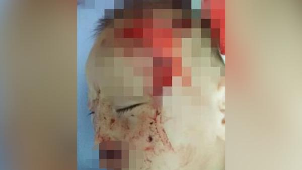 1岁半女童遭狗扑倒撕咬，额头被咬出洞