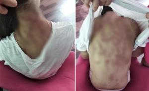 宜宾12岁女孩遭继母虐打伤痕累累，生父：打她是为教育她